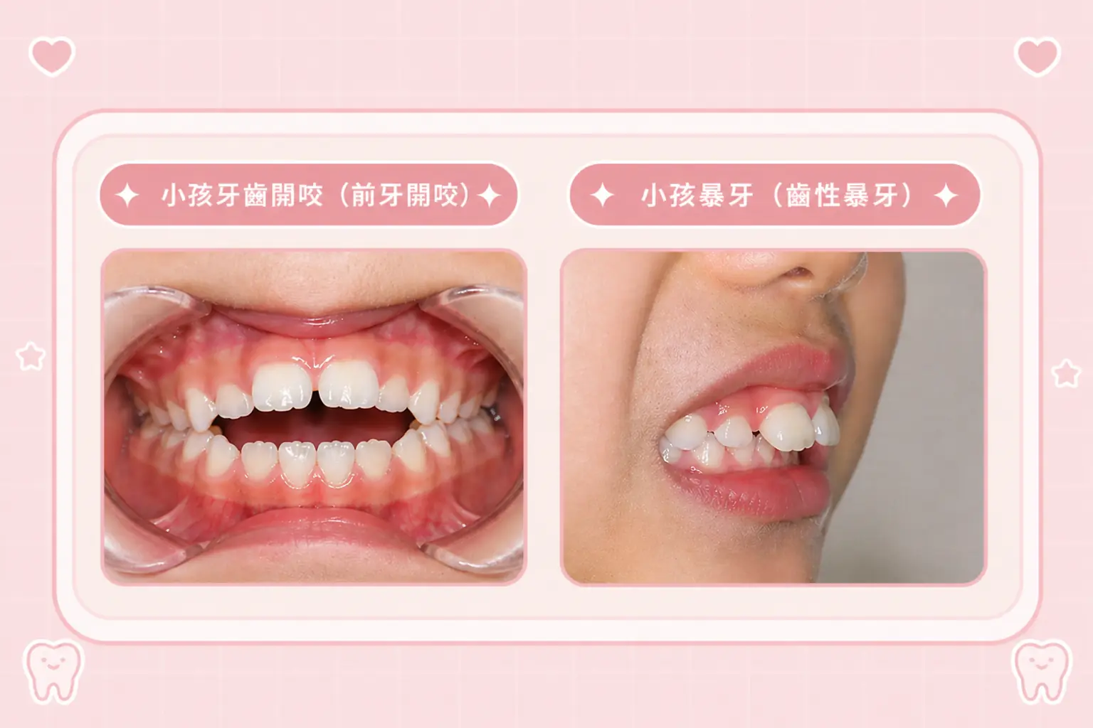 口腔習慣相關的前牙開咬與暴牙口內照