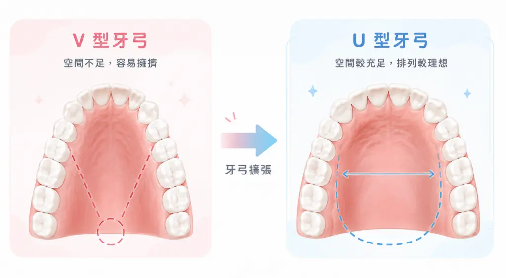 V 型與 U 型牙弓對照：牙弓擴張前後的上顎空間示意