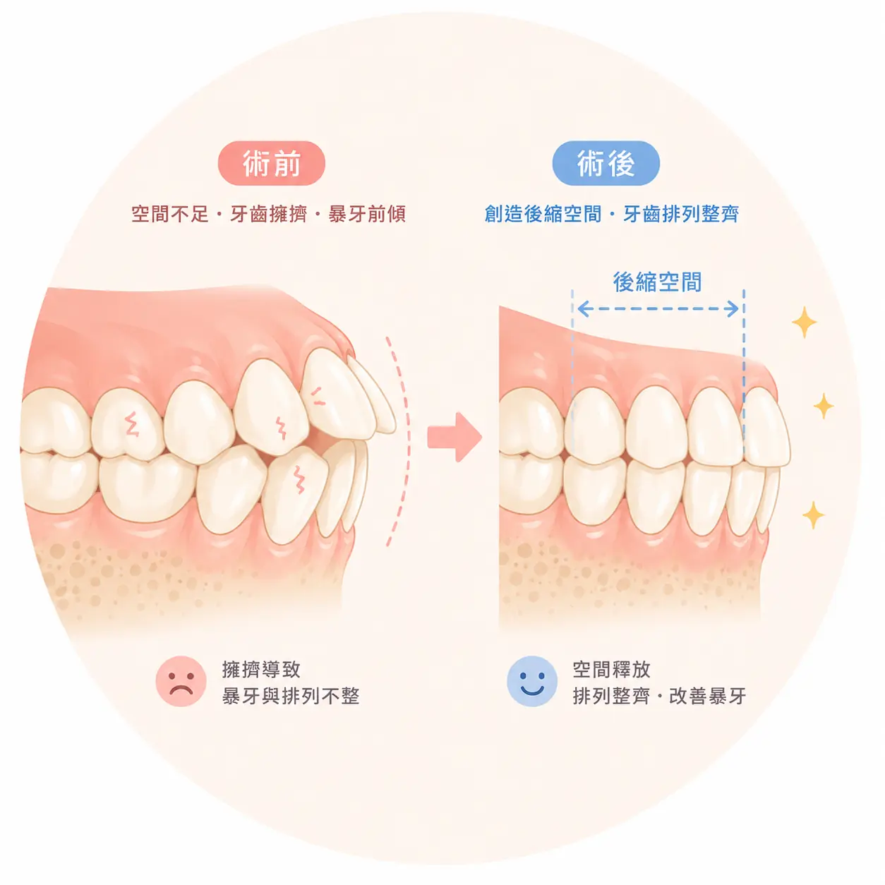 拔牙矯正示意圖：擁擠暴牙利用後縮空間重新排列