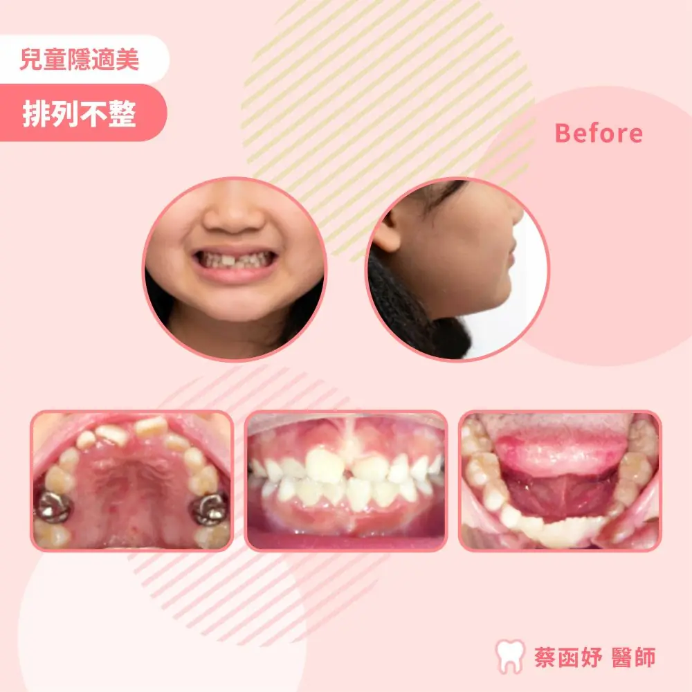 兒童隱適美牙齒排列不整案例：治療前笑容、側臉與口內照片