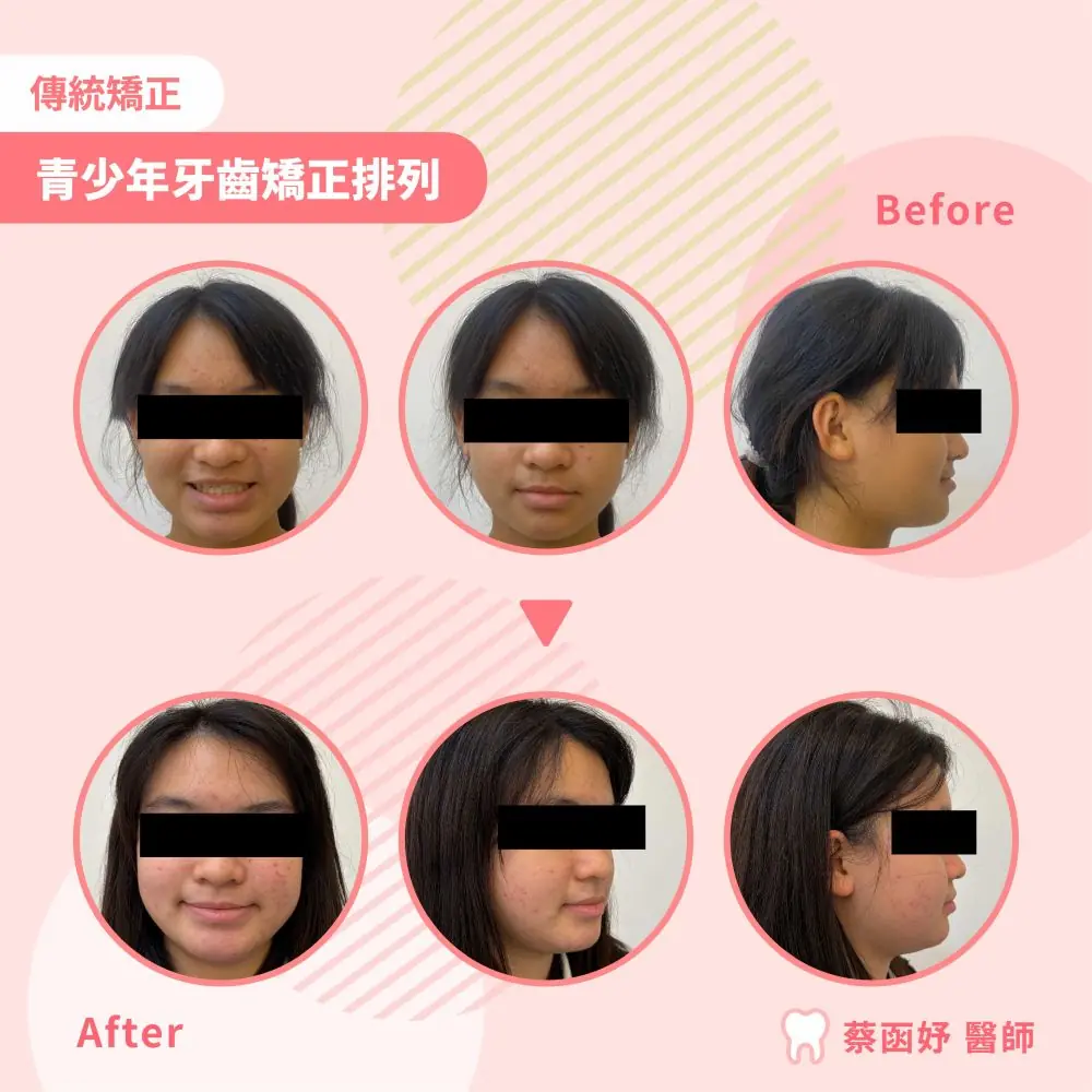 青少年傳統矯正：治療前後正面與側面臉型對照（已遮眼）