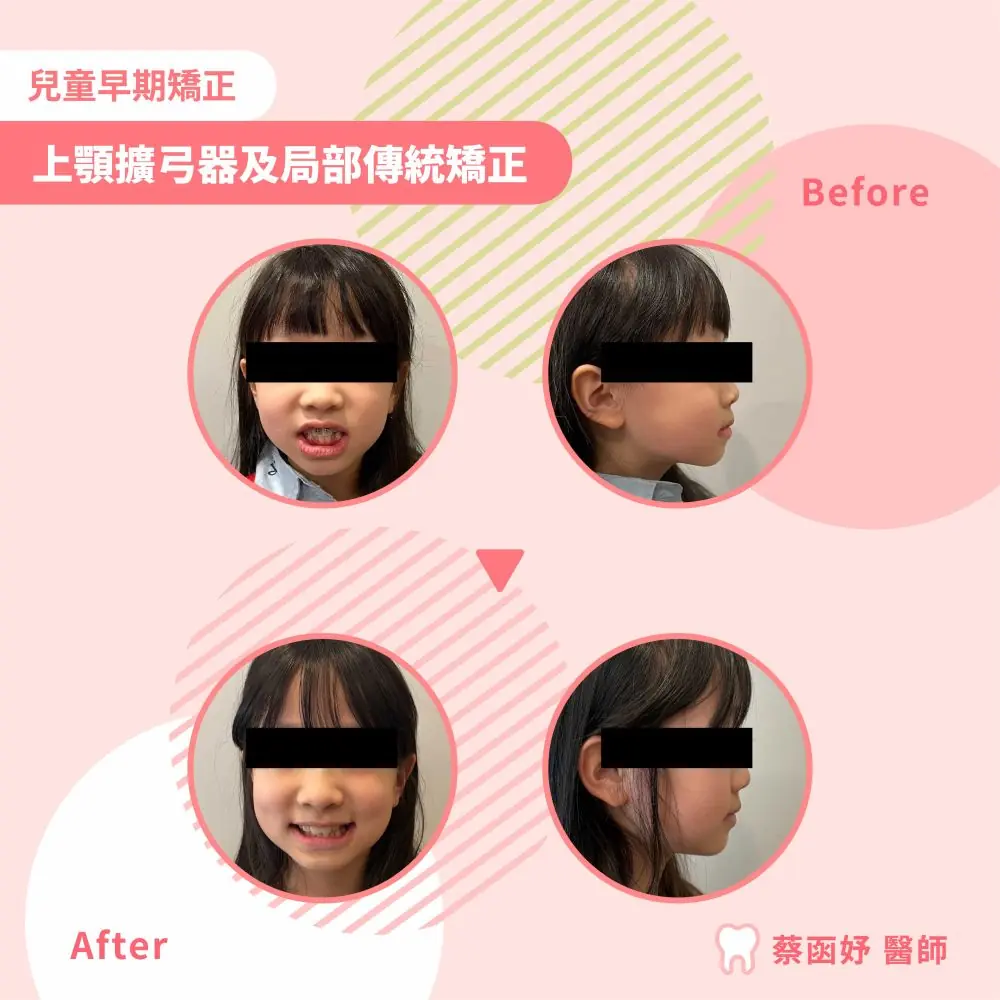 兒童上顎擴弓案例 8–9 歲 治療前後臉部照（已遮眼）