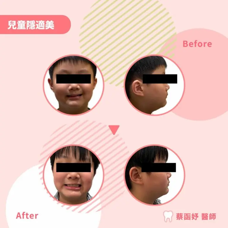 兒童隱適美案例｜7–8 歲暴牙（門牙前突）與牙弓狹窄案例照片