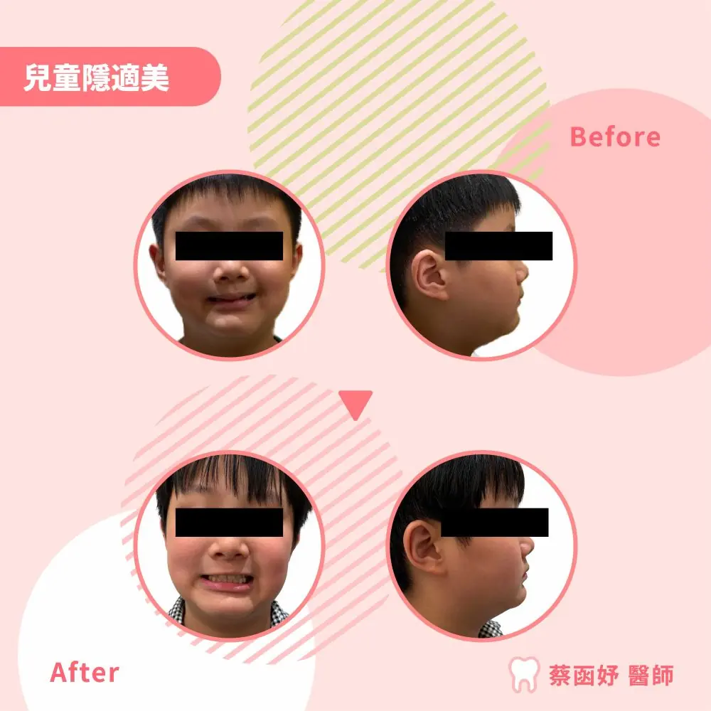 兒童隱適美案例矯正前後對照：遮眼的正面與側面臉部照