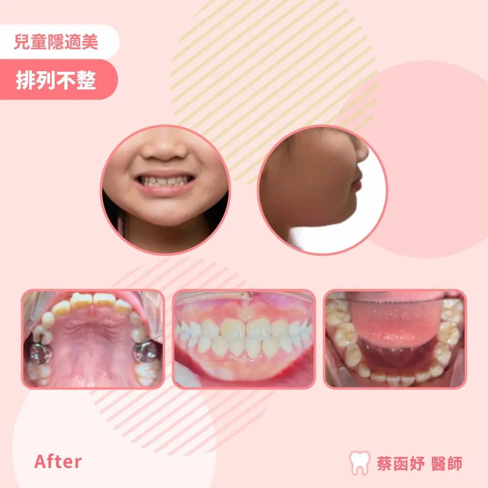 兒童隱適美牙齒排列不整案例：治療後笑容、側臉與口內照片