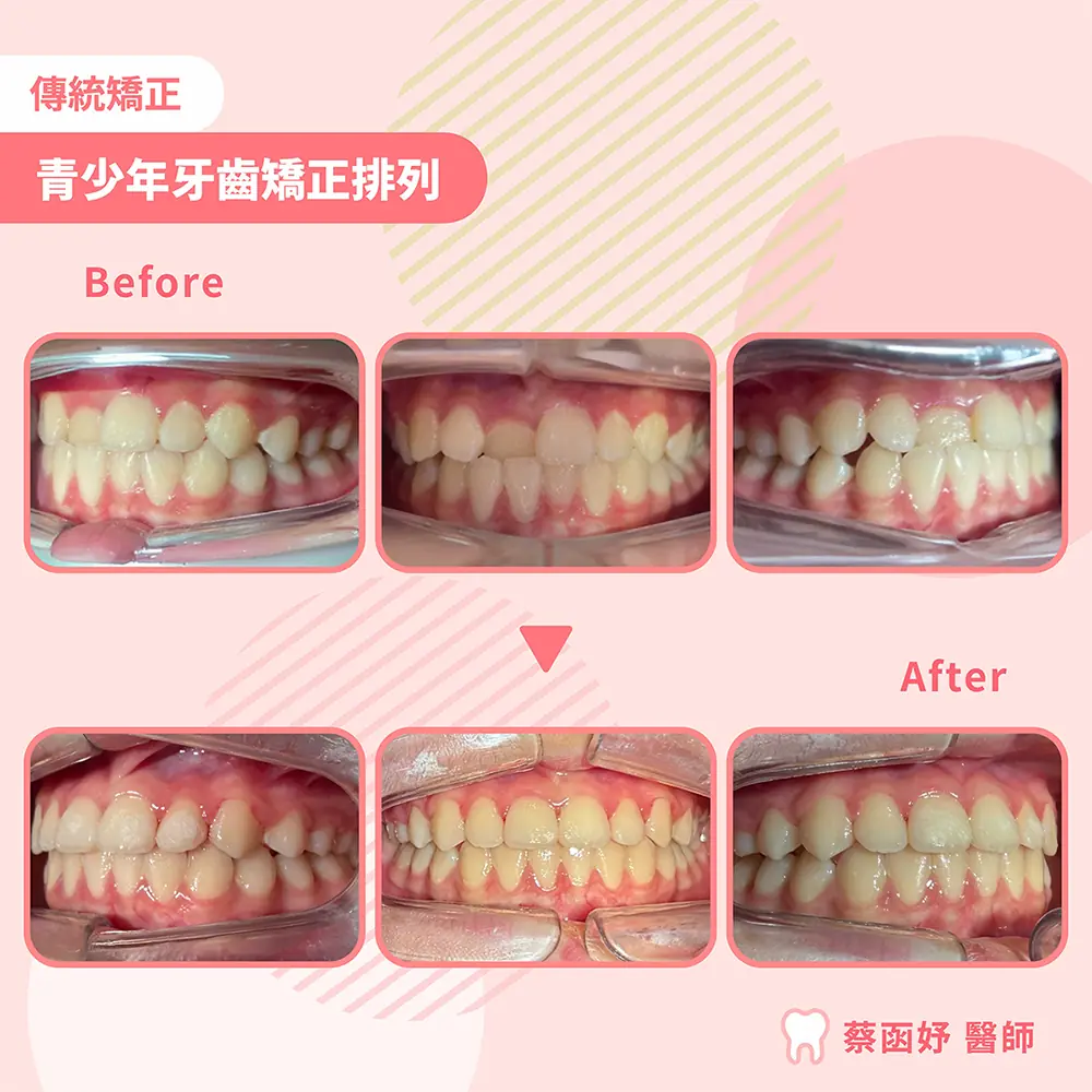 青少年傳統矯正：牙齒排列，治療前後正面及兩側咬合對照