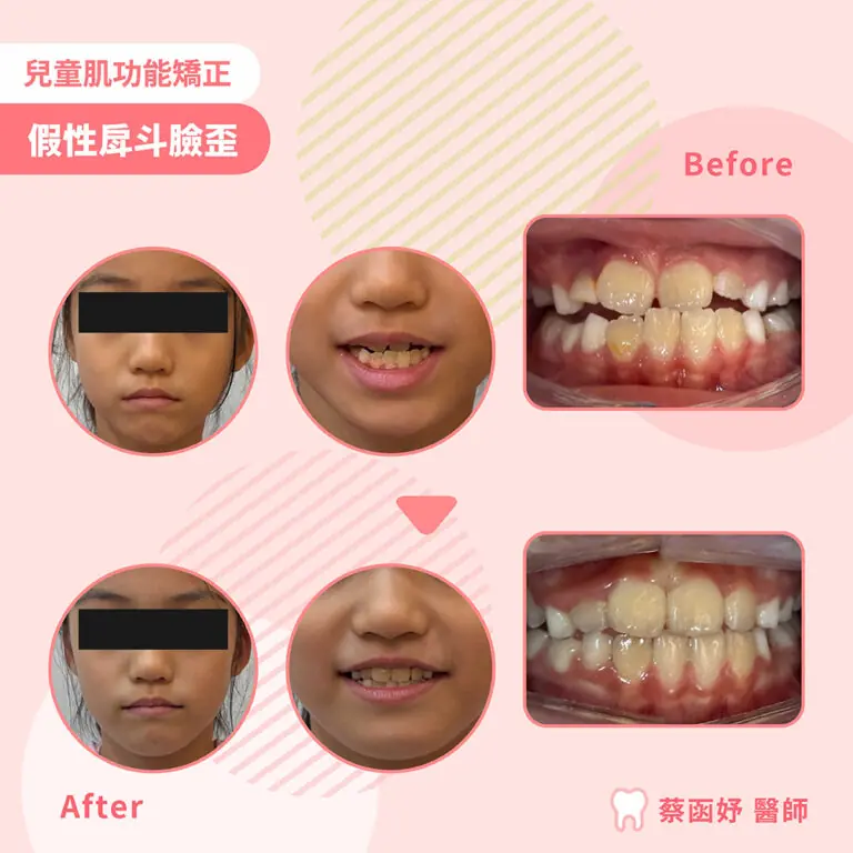 兒童肌功能矯正案例｜7–8 歲假性戽斗（前牙反咬）案例照片