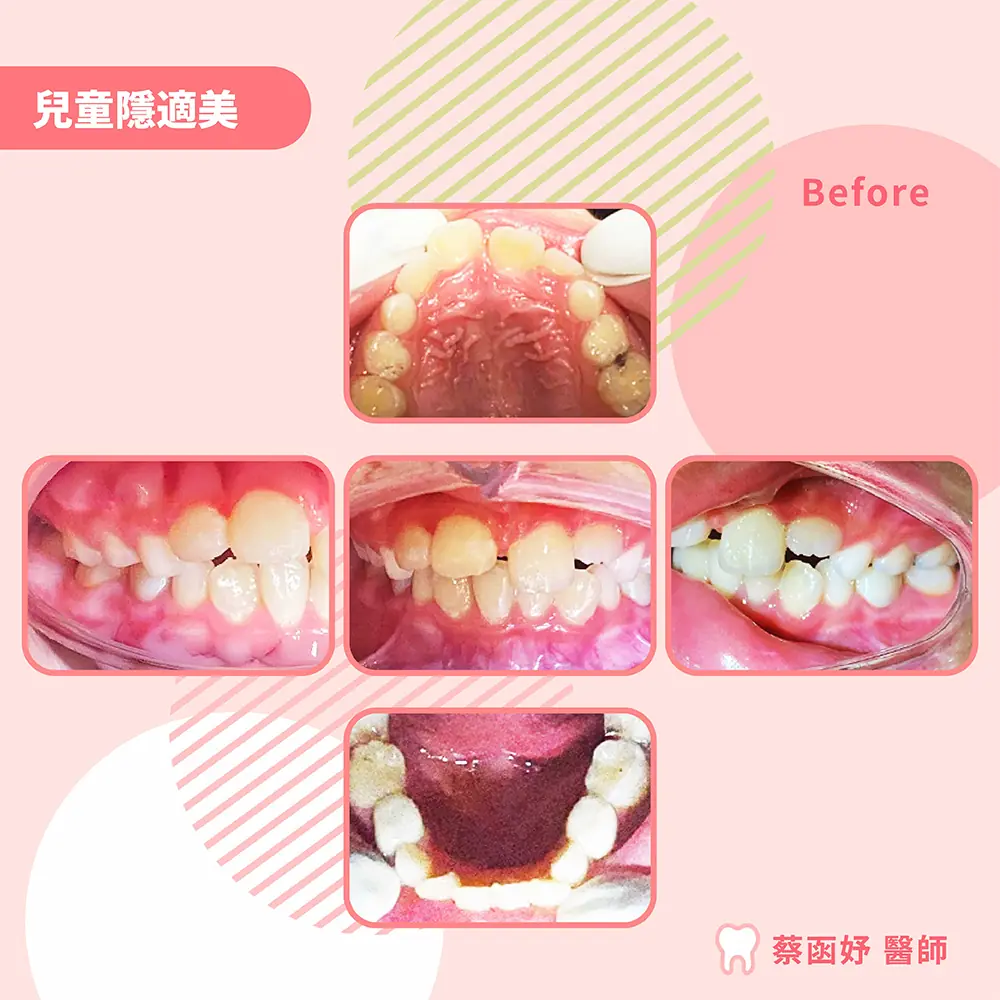 兒童隱適美案例 7–8 歲暴牙與牙弓狹窄 治療前口內照