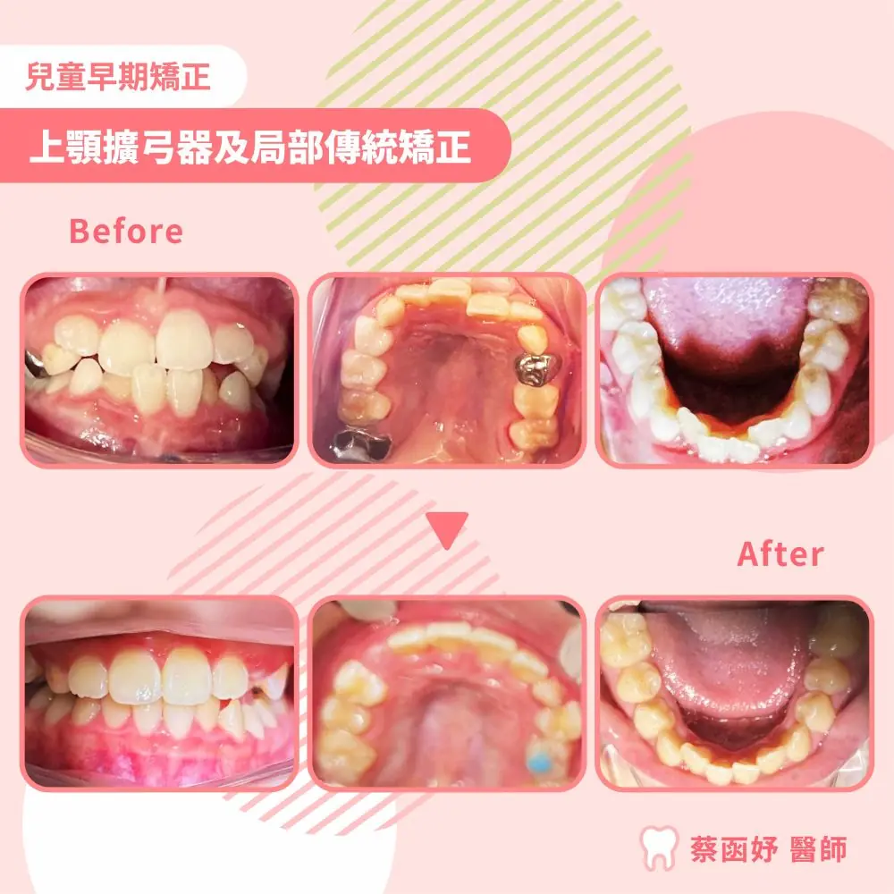 兒童上顎擴弓案例 8–9 歲 治療前後口內照