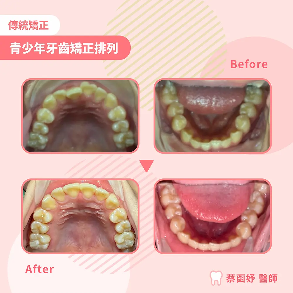 青少年傳統矯正：牙齒排列，治療前後上下顎咬合面對照