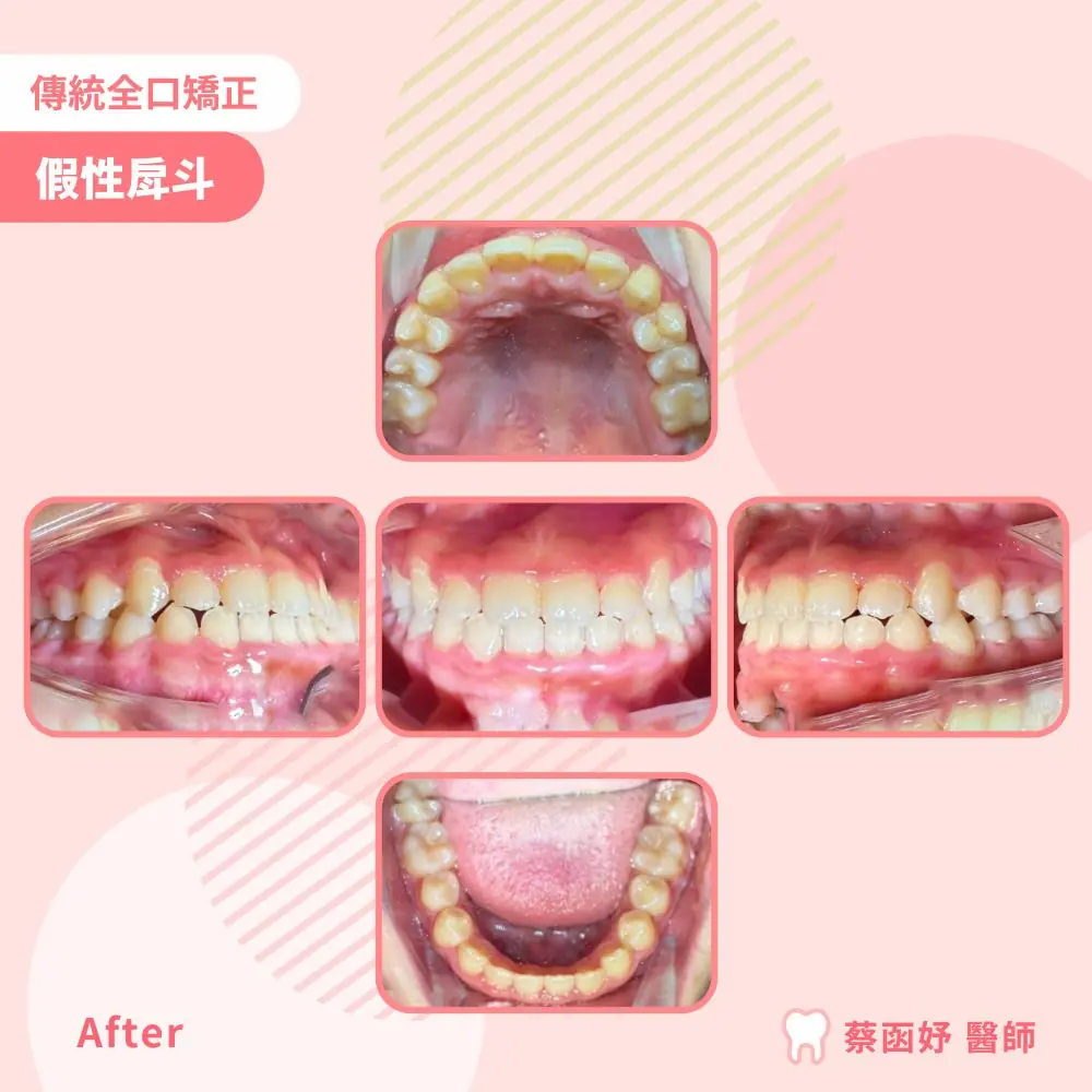 青少年傳統全口矯正：假性戽斗，治療後的口內齒列照