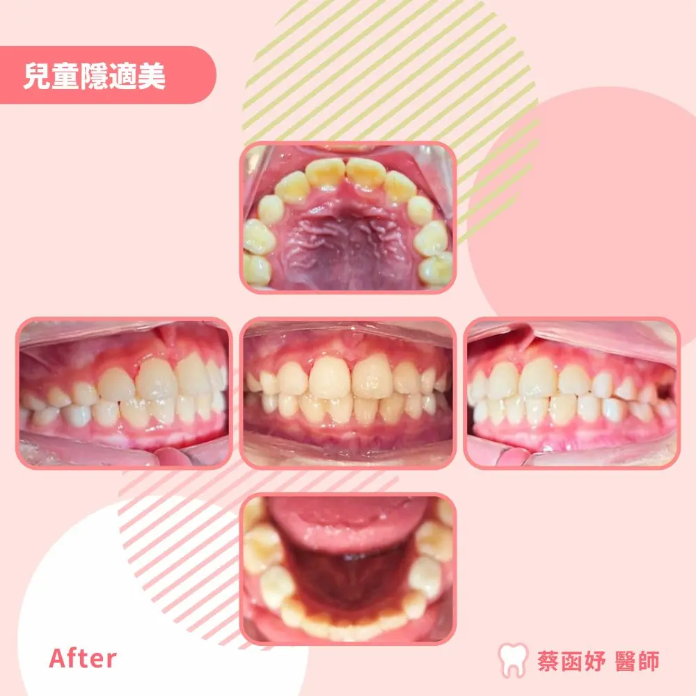 兒童隱適美案例 7–8 歲暴牙與牙弓狹窄 治療後口內照