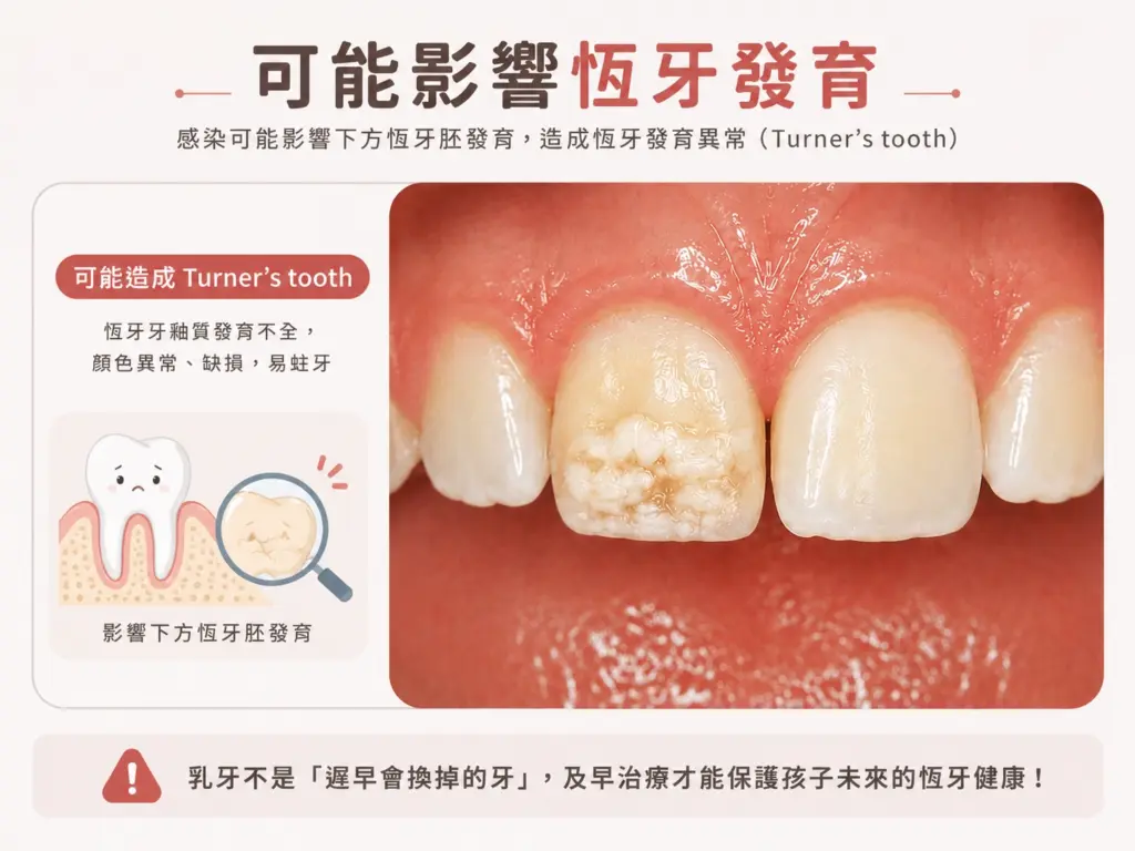 乳牙感染可能影響恆牙發育（Turner's tooth）的衛教圖