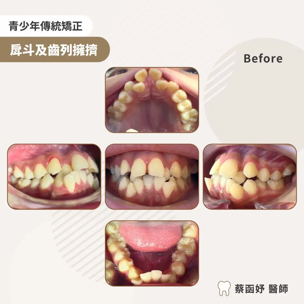 青少年傳統矯正嚴重齒列擁擠案例：治療前口內照片