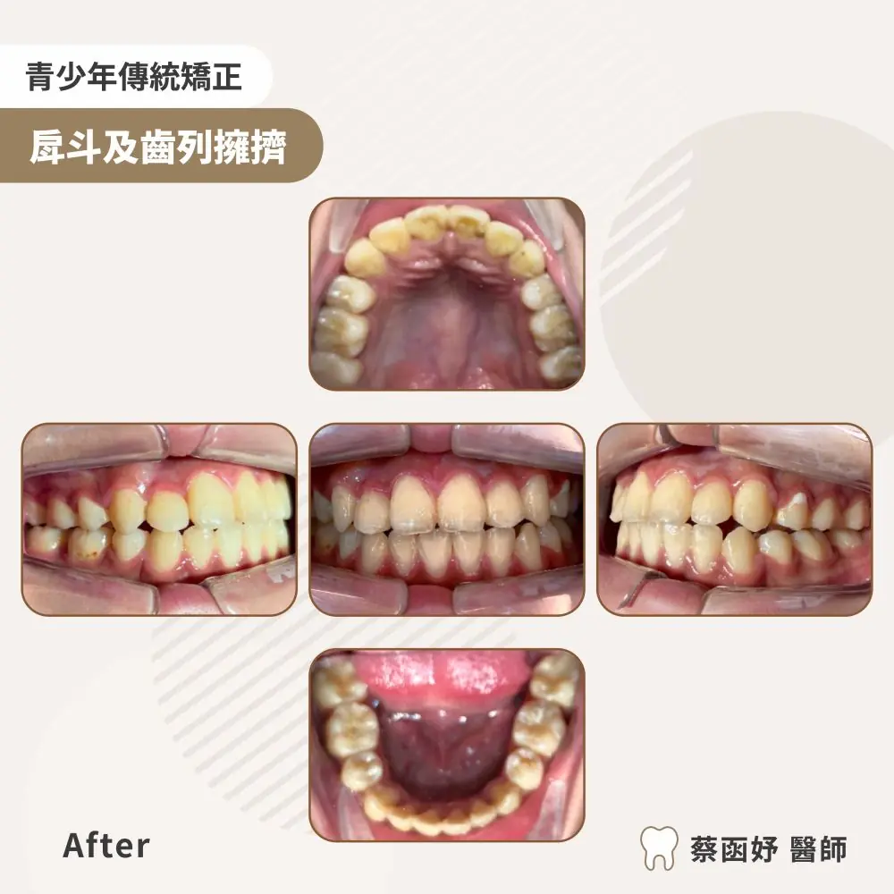 青少年傳統矯正嚴重齒列擁擠案例：治療後口內照片
