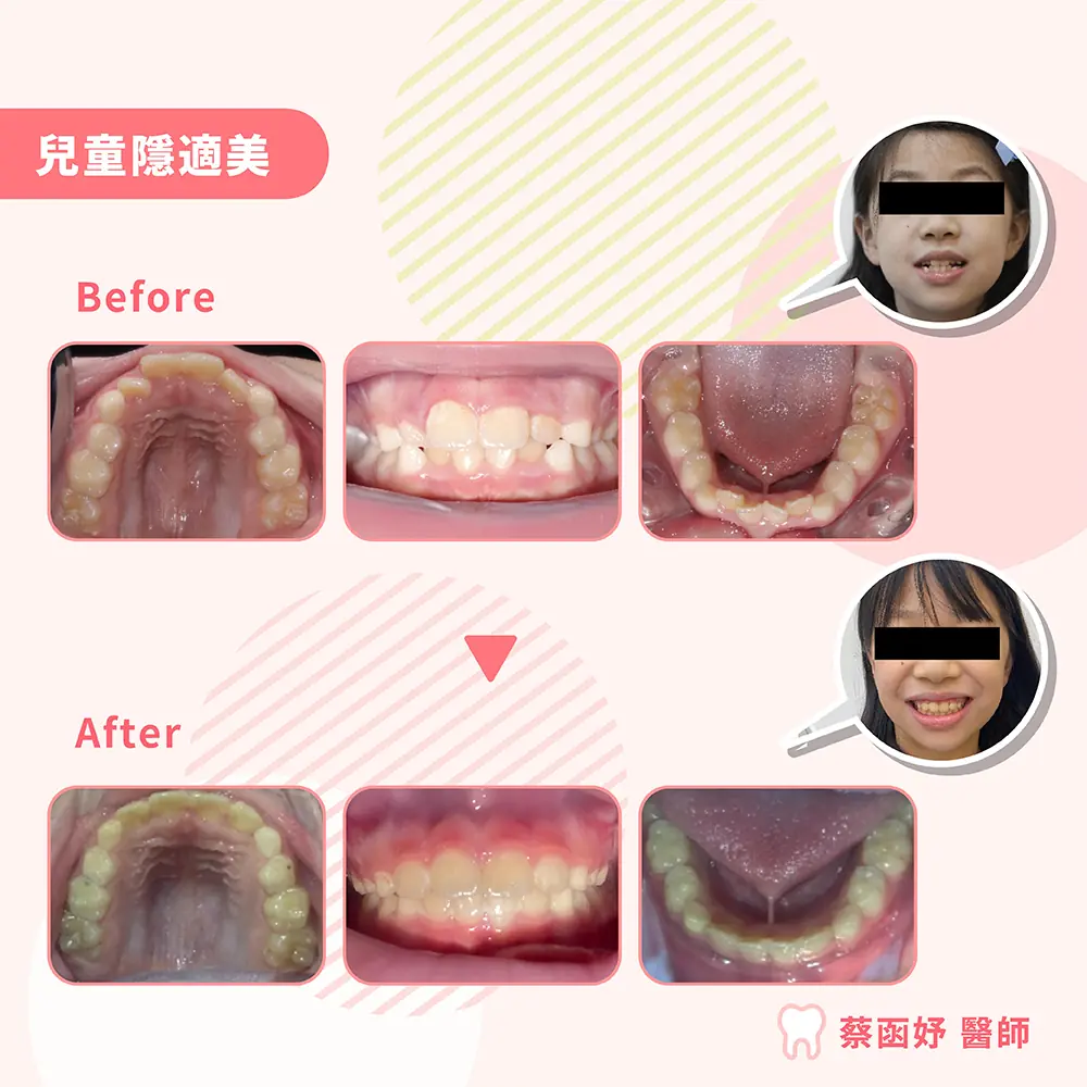 兒童隱適美案例矯正前後對照：上顎、正面與下顎口內照，以及遮眼的正面笑容照