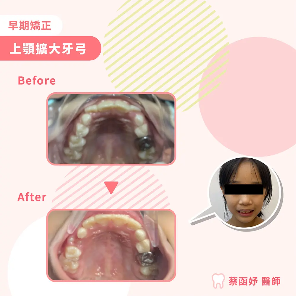 兒童早期矯正：上顎擴大牙弓，治療前後上顎咬合面對照