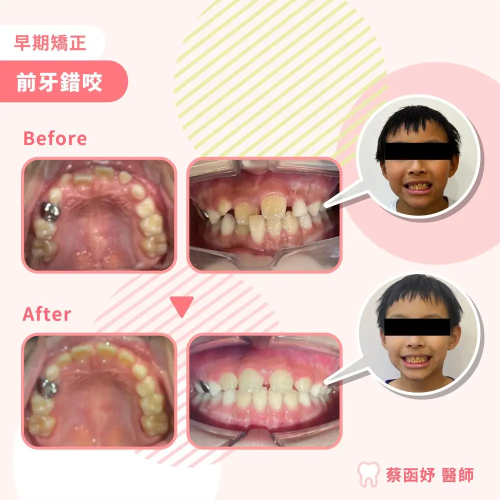 兒童早期矯正：前牙錯咬，治療前後上顎與正面齒列對照