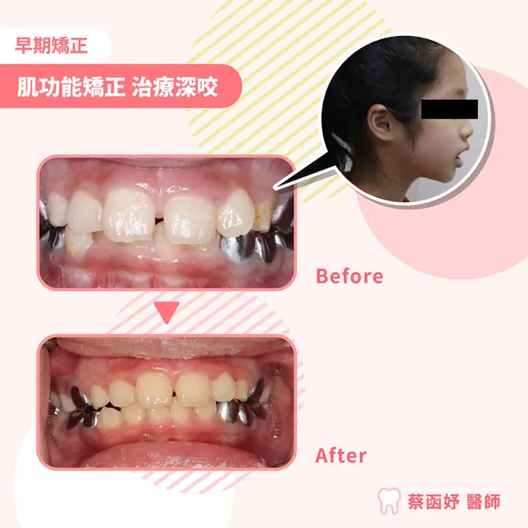 兒童肌功能矯正案例｜7–8 歲深咬與下巴後縮案例照片