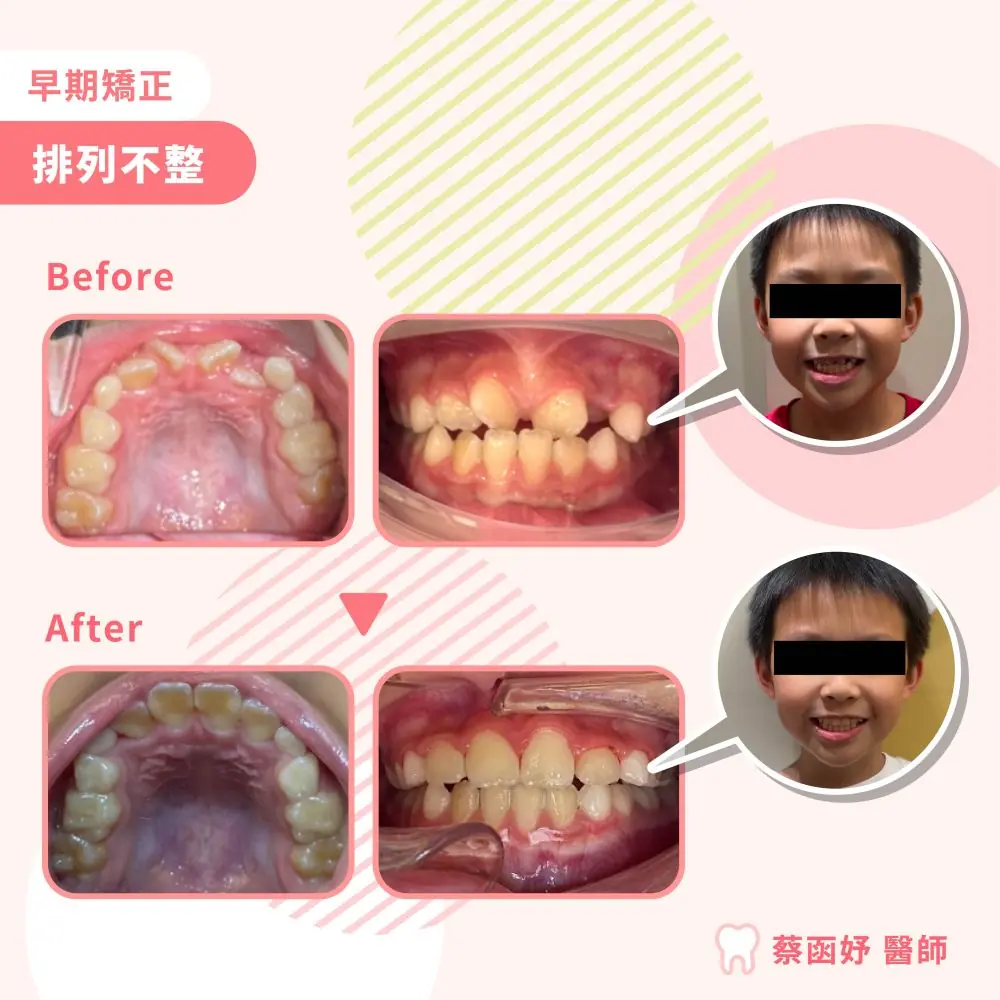 局部矯正（2 by 4）案例｜7–8 歲牙齒亂（前牙擁擠）