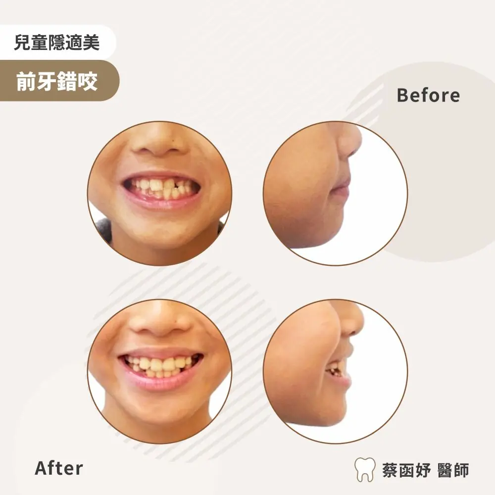 兒童隱適美：9 歲換牙期前牙錯咬，治療前後笑容與側臉對照