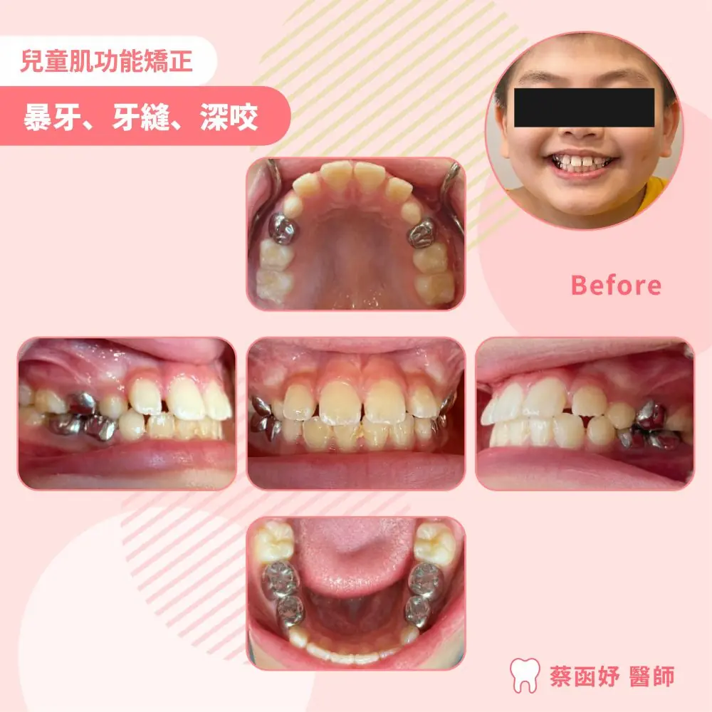 兒童上排門牙前突與牙縫肌功能矯正案例照片 2
