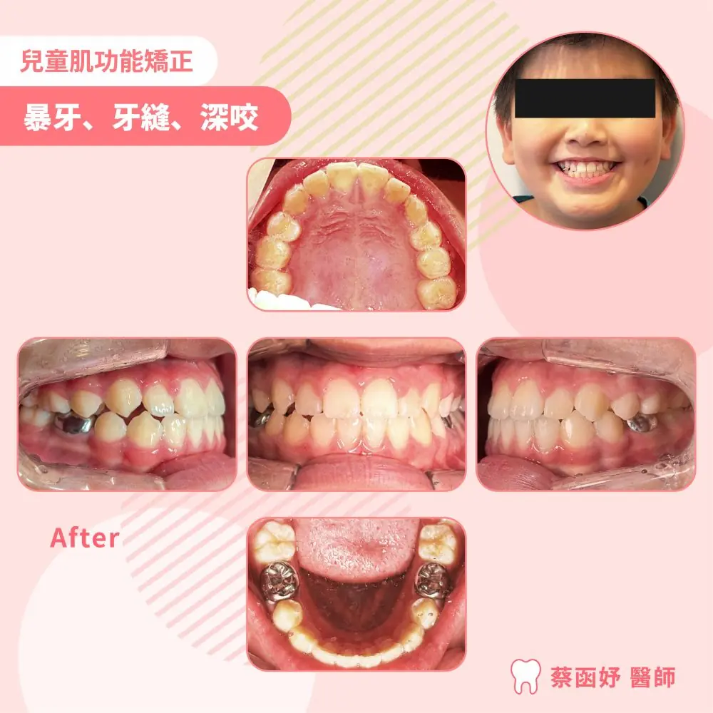 兒童上排門牙前突與牙縫肌功能矯正案例照片 3