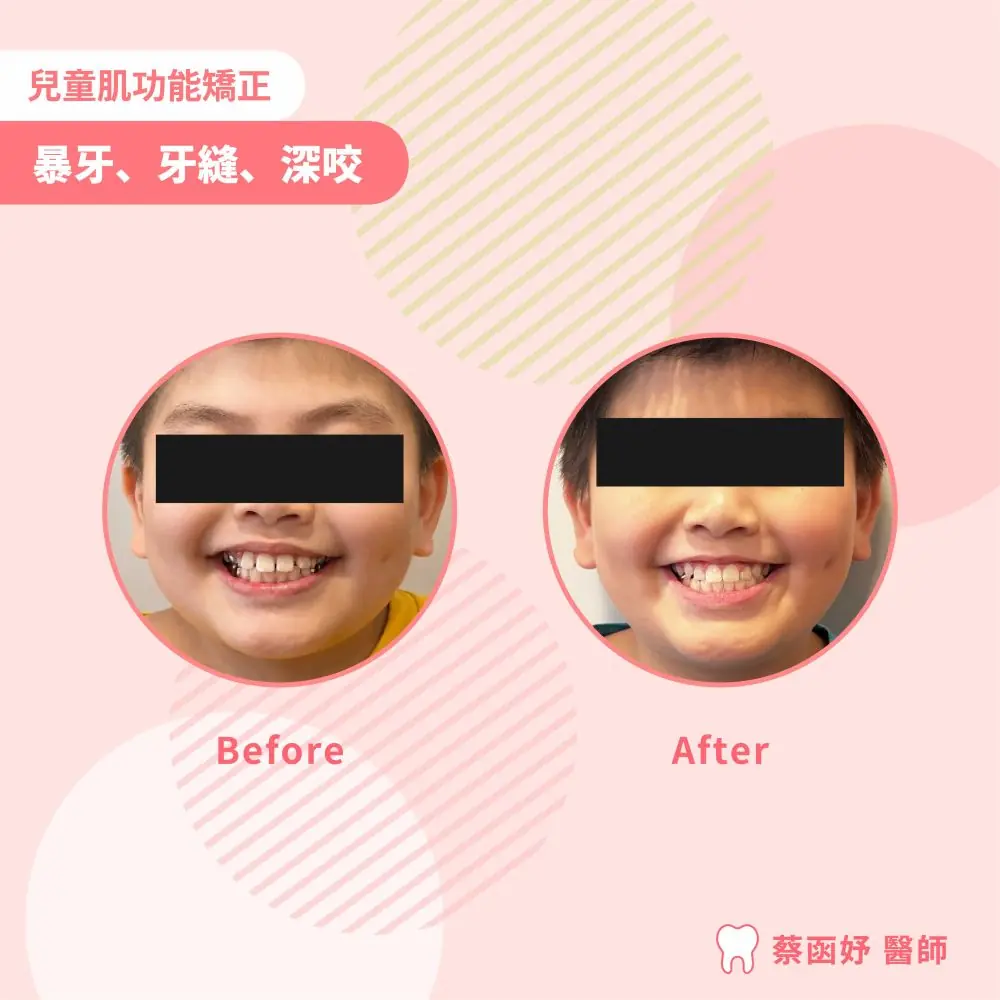 兒童上排門牙前突與牙縫肌功能矯正案例照片 1