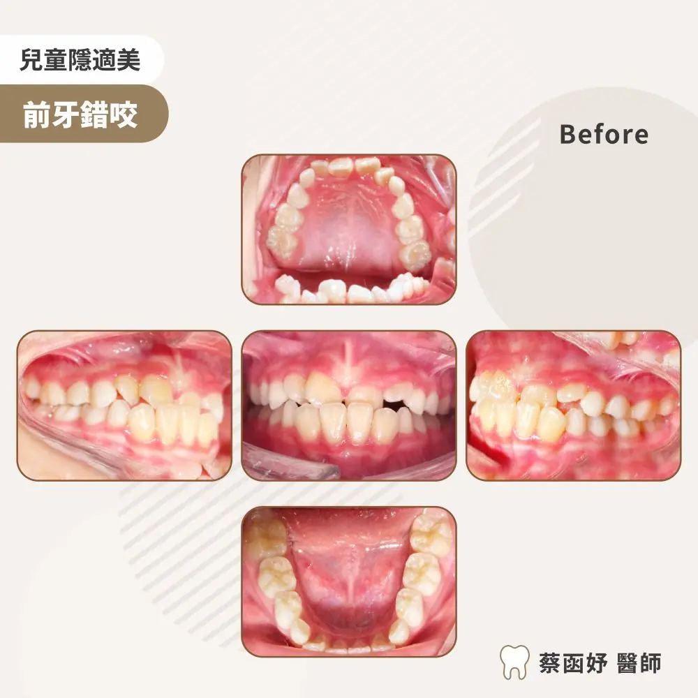兒童隱適美前牙錯咬案例：治療前口內照片