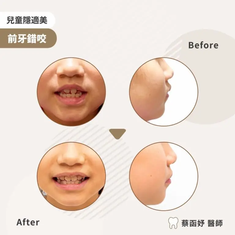 兒童隱適美：8–9 歲前牙錯咬，治療前後笑容與側臉輪廓對照