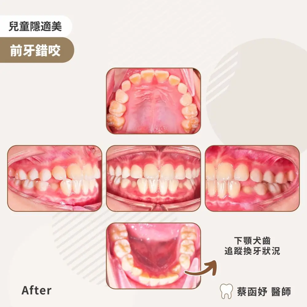 兒童隱適美前牙錯咬案例：治療後口內照片