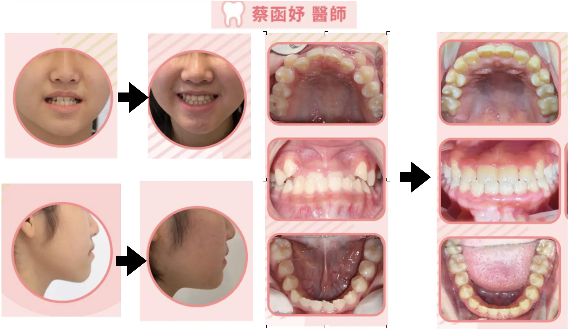 青少年傳統全口矯正：前牙反咬，治療前後臉型與口內齒列對照