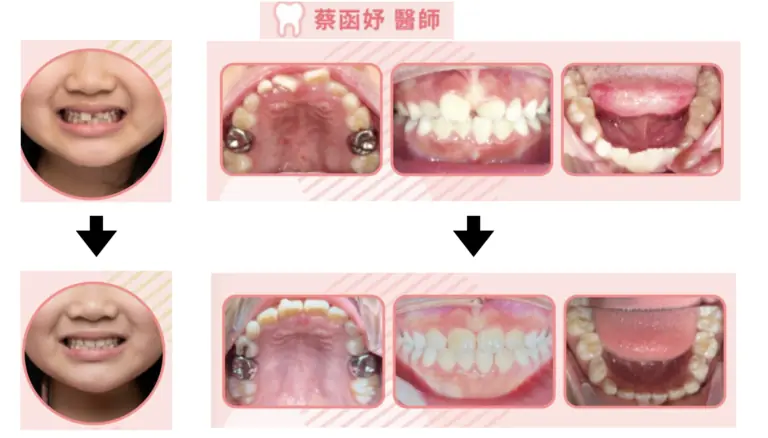 兒童隱適美案例｜8–9 歲牙齒排列不整（前牙擁擠與錯咬）案例照片