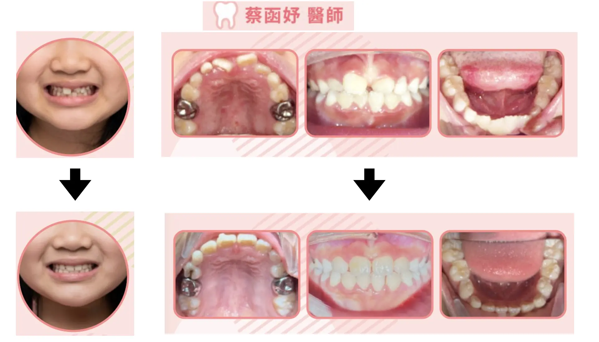 兒童隱適美案例矯正前後對照：微笑照與上顎、正面、下顎口內照