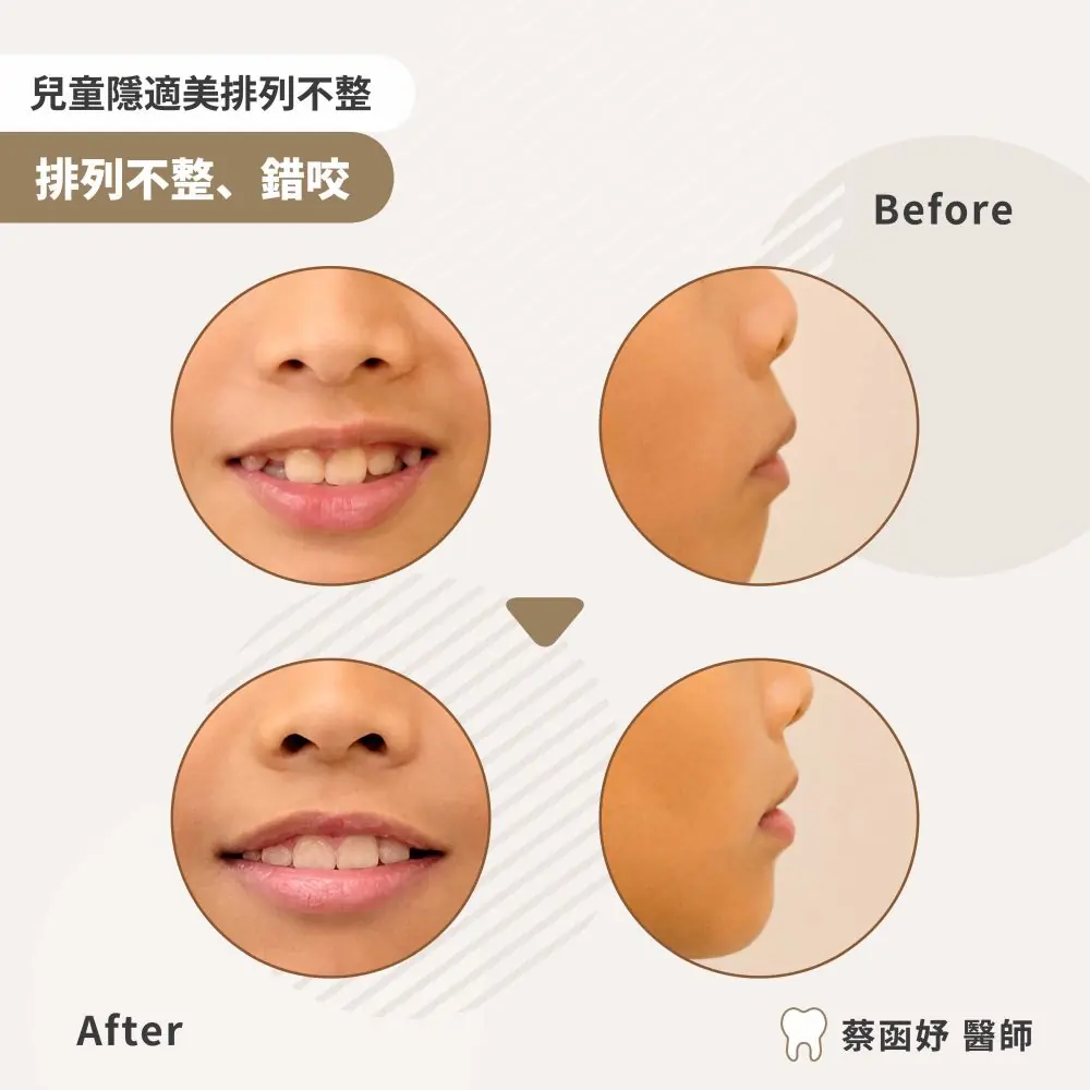 兒童隱適美前牙擁擠案例：治療前後臉部照片