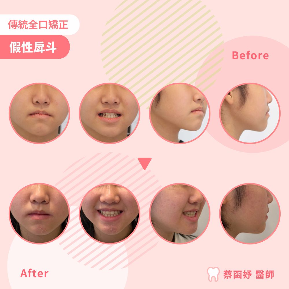 青少年傳統全口矯正：假性戽斗，治療前後臉部與笑容對照