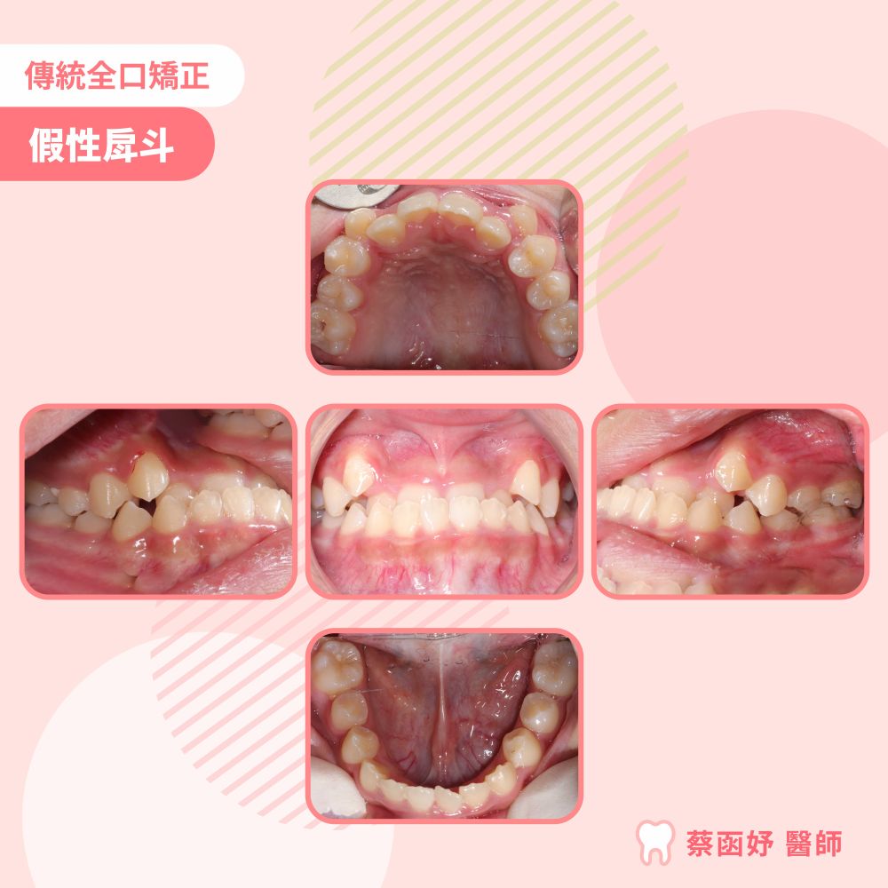 青少年傳統全口矯正：假性戽斗，治療前的口內齒列照