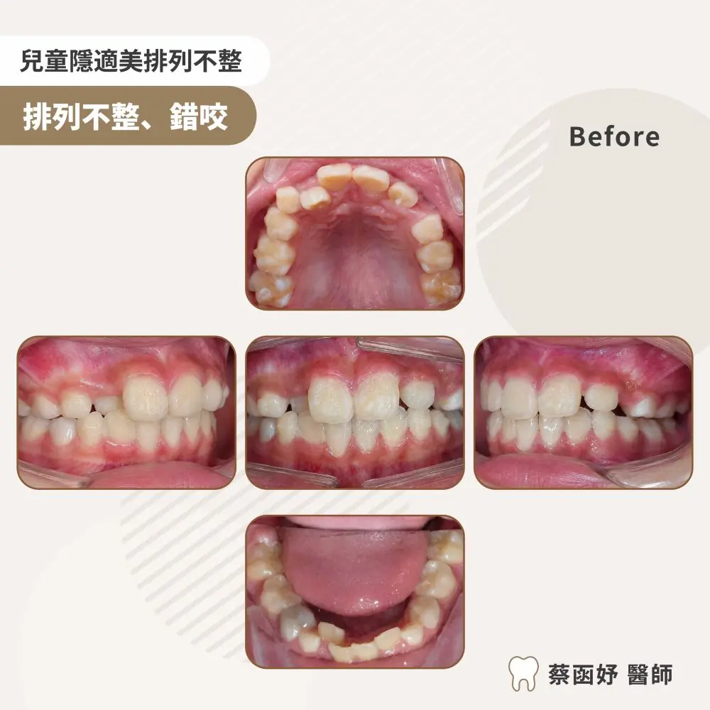兒童隱適美前牙擁擠案例：治療前口內照片