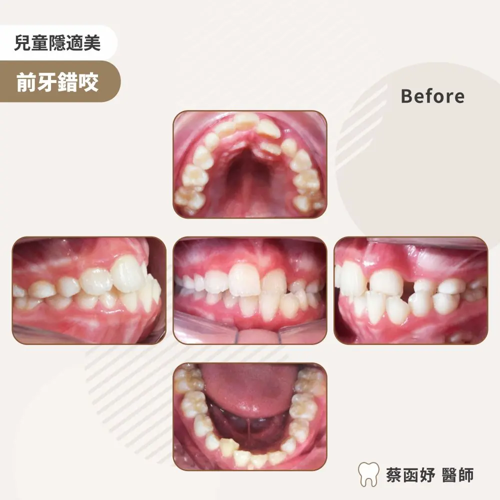 兒童隱適美前牙錯咬案例：治療前口內照片