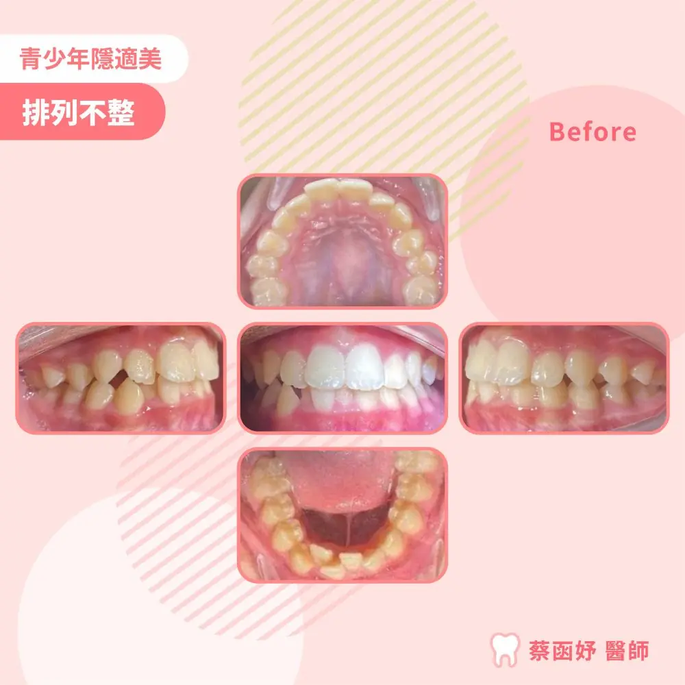 青少年隱適美下排牙齒擁擠案例：治療前口內照片