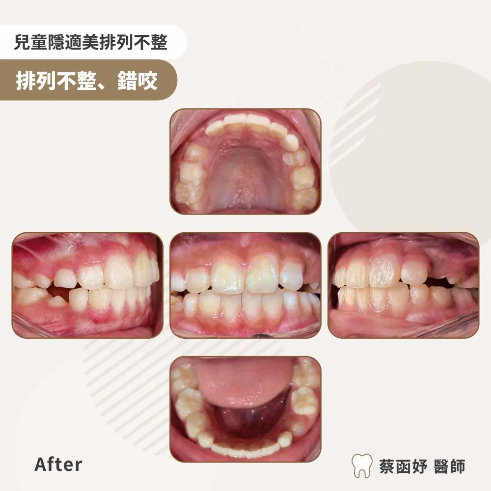 兒童隱適美前牙擁擠案例：治療後口內照片