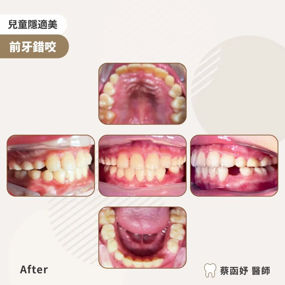 兒童隱適美前牙錯咬案例：治療後口內照片