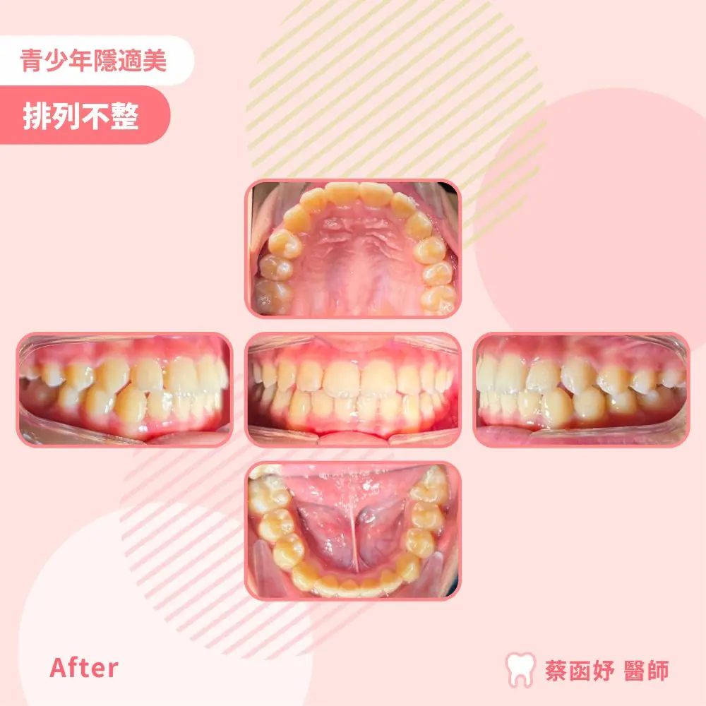 青少年隱適美下排牙齒擁擠案例：治療後口內照片