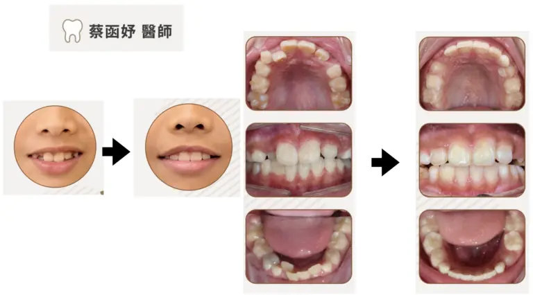 兒童隱適美：8 歲換牙期前牙擁擠，治療前後笑容與口內齒列對照