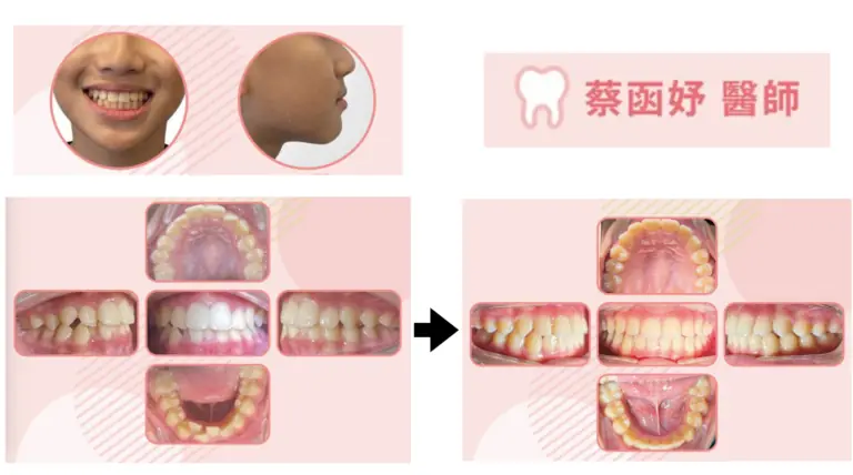 青少年隱適美案例｜11–12 歲下排牙齒擁擠與排列不整案例照片