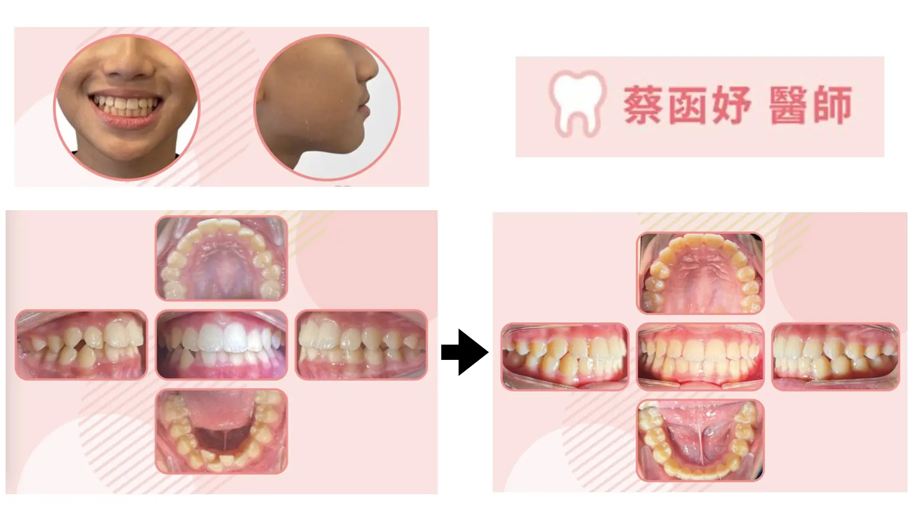 青少年隱適美：11–12 歲下排牙齒擁擠，治療前後口內齒列對照