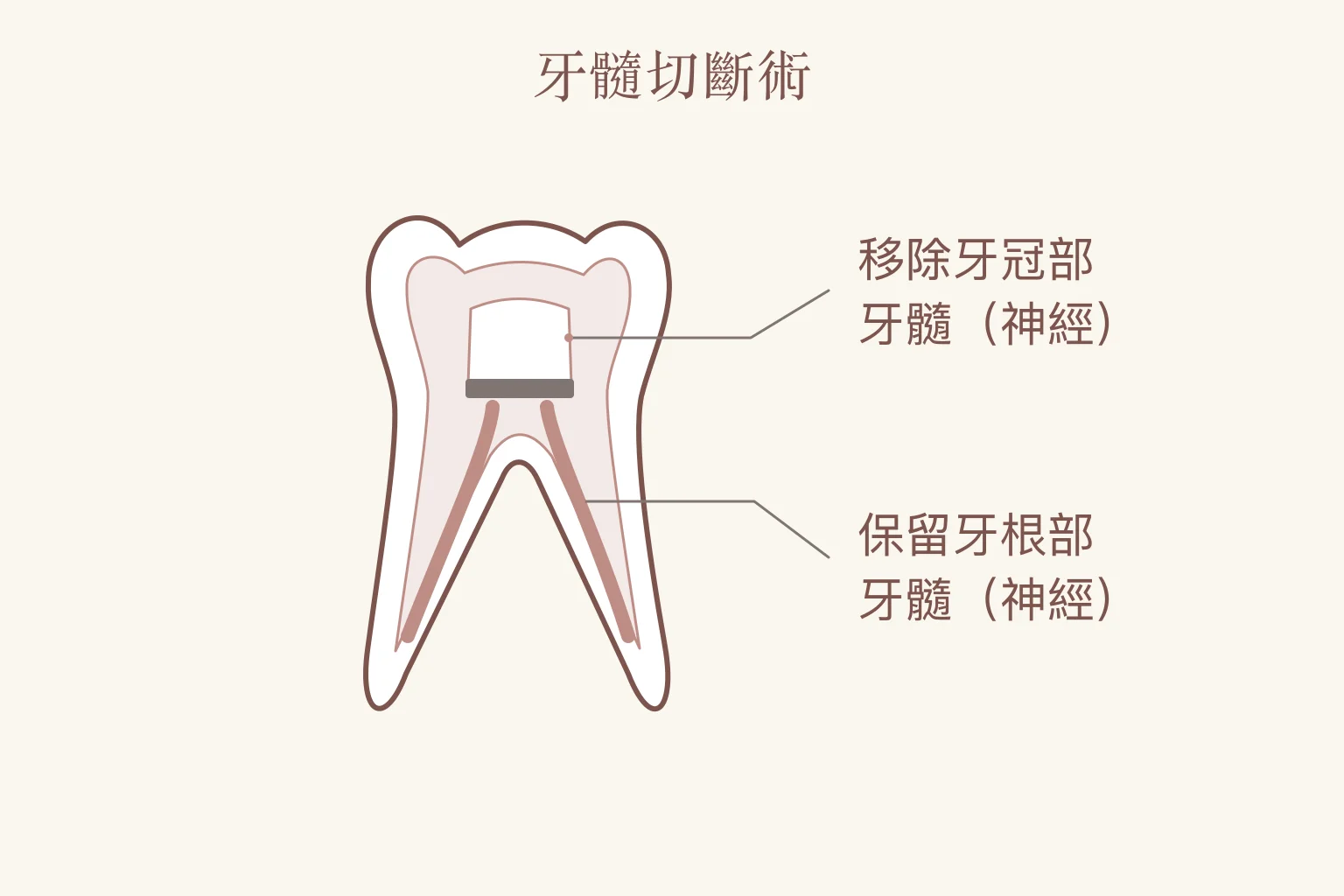 乳牙活髓治療的牙髓切斷術示意：移除牙冠部牙髓（神經），保留牙根部牙髓（神經）。