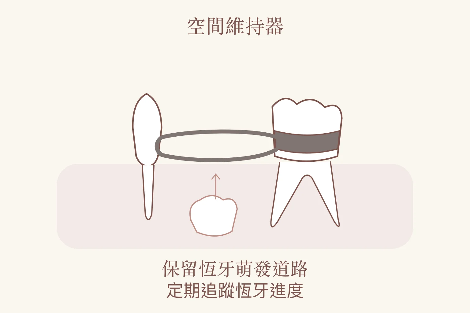 兒童空間維持器局部牙列示意：帶環與線圈支撐缺牙空間，並追蹤恆牙萌發。