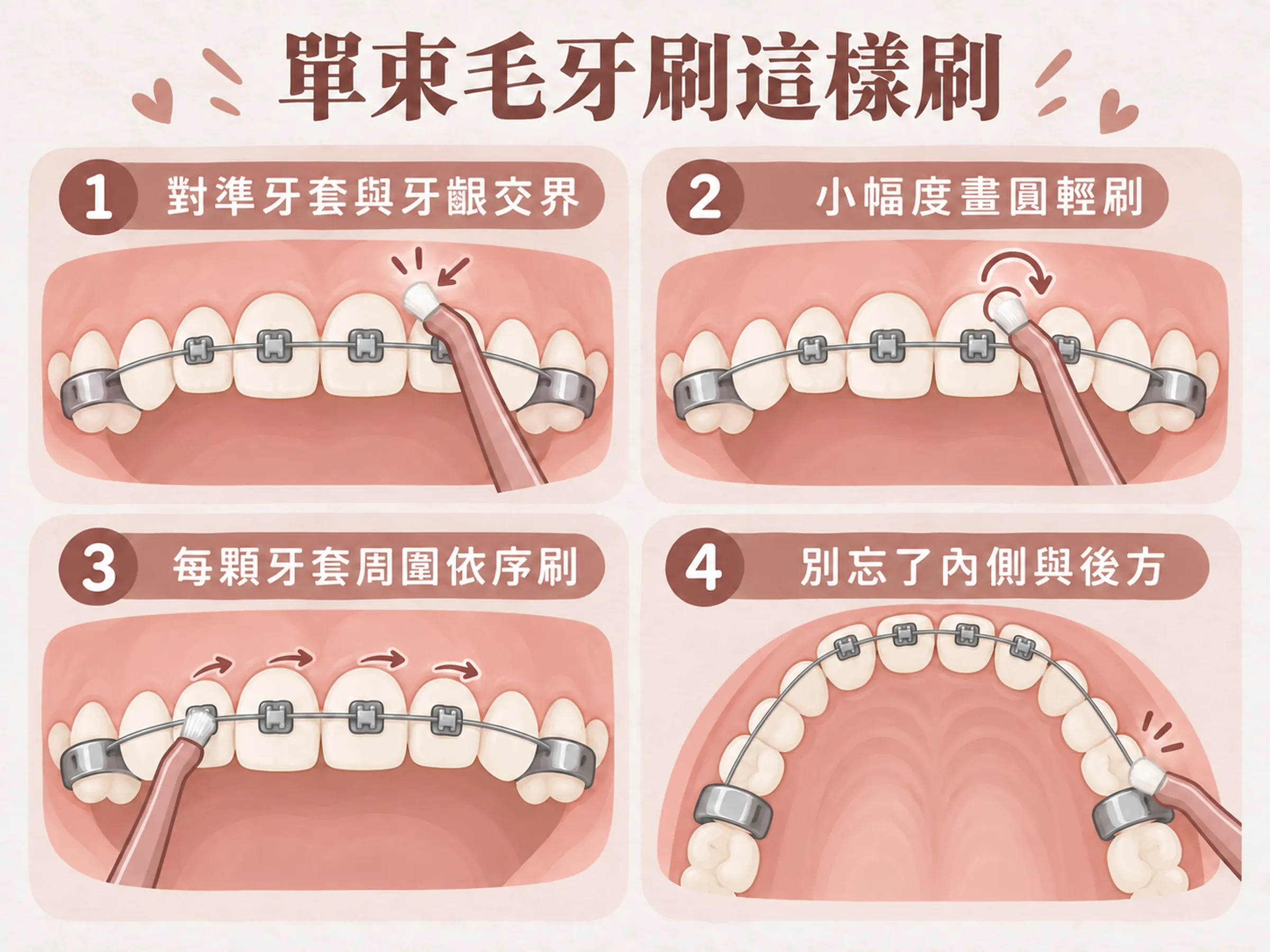 2 by 4 單束毛牙刷清潔步驟示意:對準牙套與牙齦交界、小幅度畫圓、依序刷牙套周圍,以及清潔牙齒內側與後方