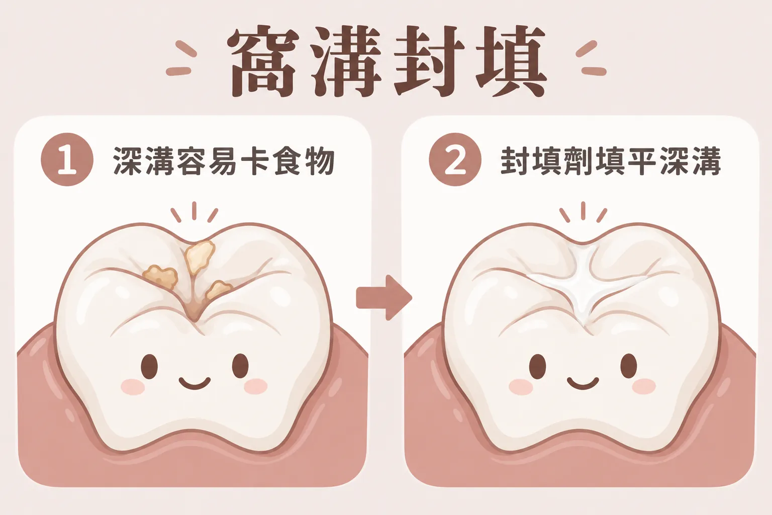 窩溝封填示意插畫:臼齒咬合面深溝容易卡食物,封填劑填平深溝